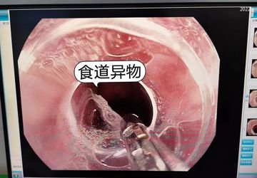 【聚焦】老人食道异物，医生妙手取出——我院消化内镜专家成功为90岁老人取出食道异物
