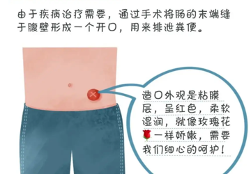 “造口人”日常居家该怎么护理？会理市人民医院伤口/造口护理门诊教你这样做！
